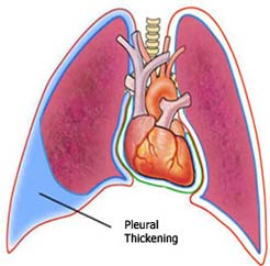 Asbestos Pleural Effusion