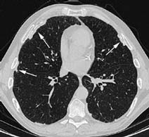 Cross section of lungs, pleural plaques