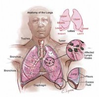 Asbestos lung cancer