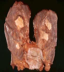 Asbestosis affected lungs