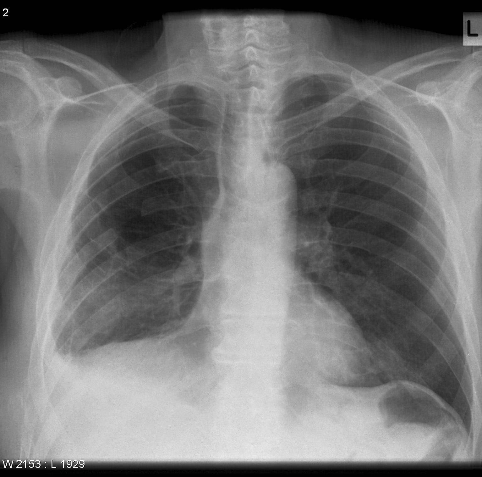 What is the state of mesothelioma in the UK?