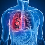 Understanding Mesothelioma: New Report Published