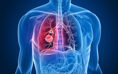 Understanding Mesothelioma: New Report Published