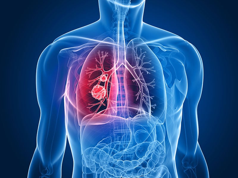 Lung Cancer